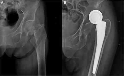 Femoral neck fracture patients with ischaemic stroke choose hemiarthroplasty or constrained liner total hip arthroplasty? A retrospective comparative study of 199 cases